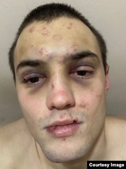 Артем Быков после одного из избиений
