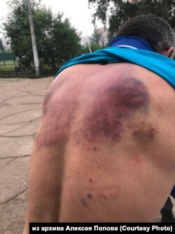 Травмы спасателя Алексея Попова после задержания росгвардейцами