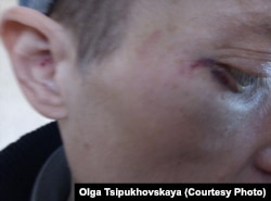 Андрей Ципуховский с синяками после избиения в психиатрической лечебнице