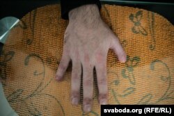 Поврежденная взрывом рука Романа