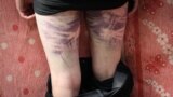 BELARUS -- Bruises on the legs of a man, who was reportedly beaten by the police, after being released from a detention center in Minsk, August 14, 2020