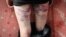 BELARUS -- Bruises on the legs of a man, who was reportedly beaten by the police, after being released from a detention center in Minsk, August 14, 2020