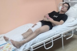 Максим Кокорин, обожженный в машине полиции подросток из Иркутска, после операции
