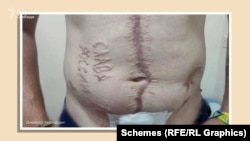 Клеймо, которое выжгли на теле Андрея Переверзева после операции