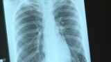 tuberculosis russia illness 