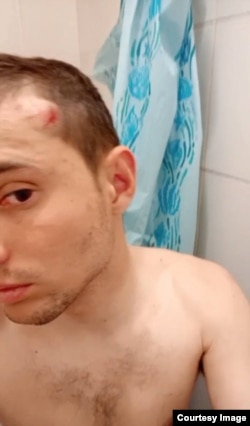 Артем Быков после очередного избиения сослуживцами